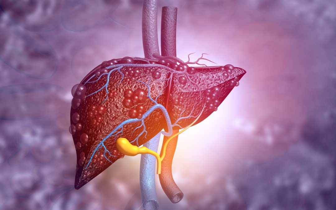 FIB-4 : nouvel outil de dépistage des maladies chroniques du foie
